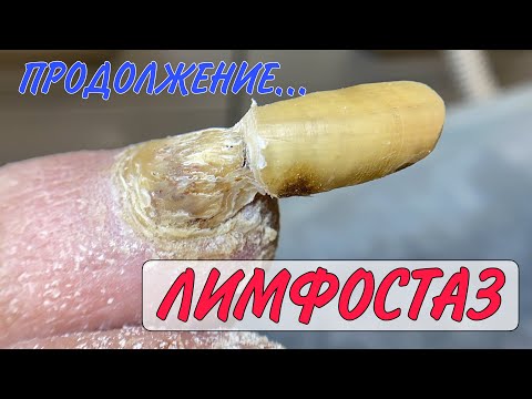 Видео: Лимфостаз / скрученные ногти / грибок ногтей / медицинский педикюр