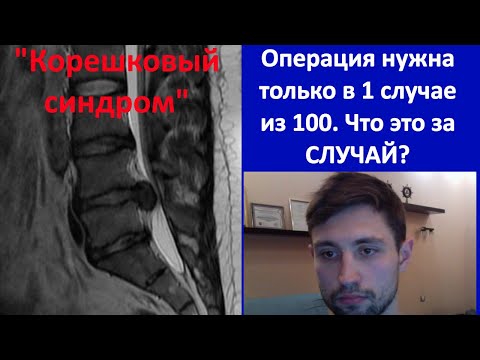 Видео: Корешковый синдром, Радикулит, клинически значимая грыжа
