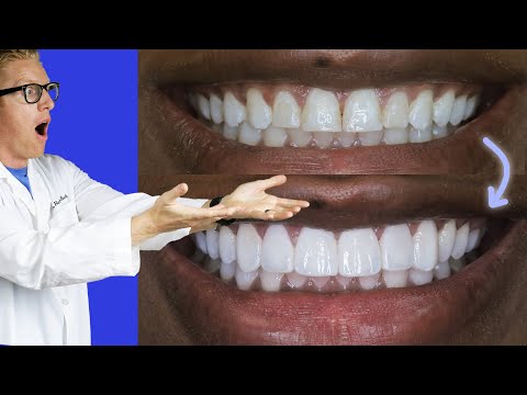 Видео: ПРЕОБРАЖЕНИЕ УЛЫБКИ С ПОМОЩЬЮ КОМПОЗИТНЫХ ВИНИРОВ! Косметическая реставрация зубов композитными в...