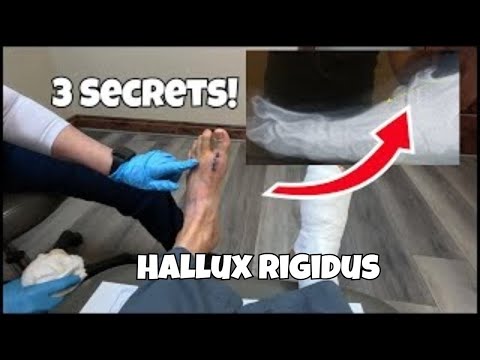 Видео: Хирургия Hallux Rigidus: три главных секрета, которые вам НУЖНО знать