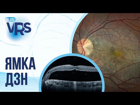 Видео: Ямка диска зрительного нерва