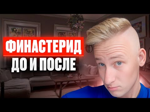 Видео: ФИНАСТЕРИД | ДО И ПОСЛЕ...РЕЗУЛЬТАТ ПОСЛЕ 10-И МЕСЯЦЕВ ИСПОЛЬЗОВАНИЯ #облысение #допосле #волосы