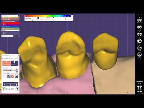 Видео: Exocad моделировка каркаса под 3D печать