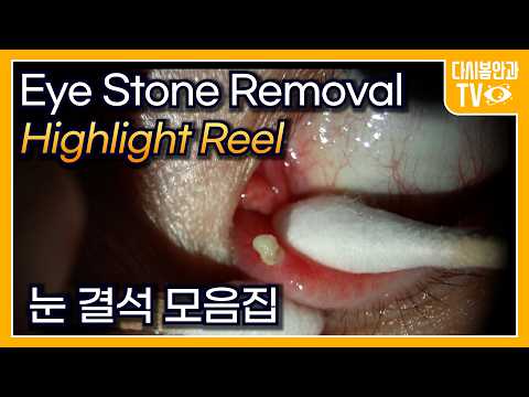 Видео: Удаление камней из глаз: Сборник за 30 минут