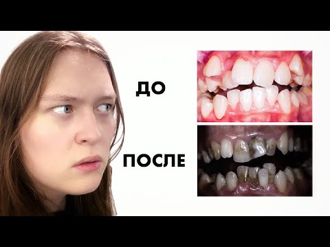 Видео: ОТКАЖИСЬ ОТ БРЕКЕТОВ ПОКА НЕ ПОЗДНО