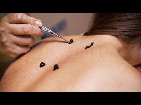 Видео: Гирудотерапия - как лечат пиявки? Школа здоровья 04/10/2014 GuberniaTV