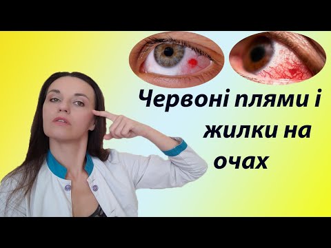 Видео: Червоні плями на очах і червоні судини на білках очей, які причини, небезпека, наслідки, лікування.