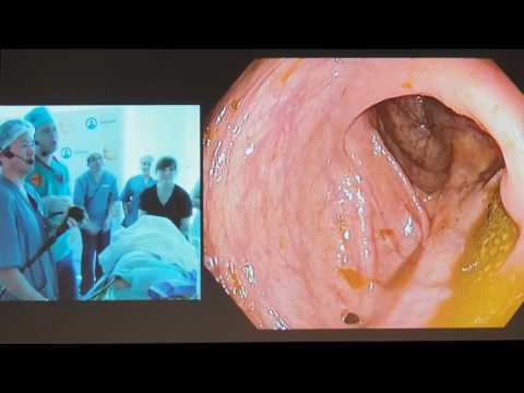 Видео: 10Live Аденокарцинома сигмовидной кишки T1N0M0 Yutaka Saito ESD OLYMPUS