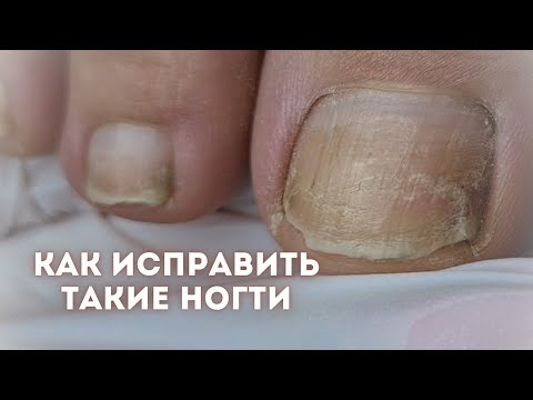 Видео: Преображение проблемных ногтей на ногах | Аппаратный педикюр | Дисковый смарт педикюр