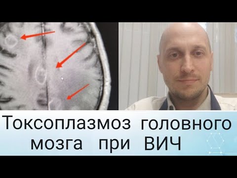 Видео: Токсоплазмоз головного мозга при ВИЧ