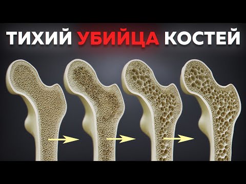 Видео: ПРИЧИНА слабых костей НЕ в дефиците кальция! / Быстрый тест на здоровье костей