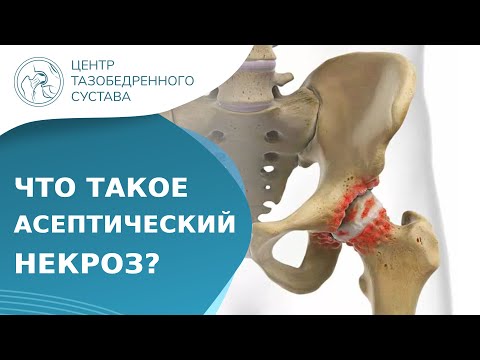 Видео: 🦵 Что такое асептический некроз головки бедренной кости? Асептический некроз головки бедра. 18+