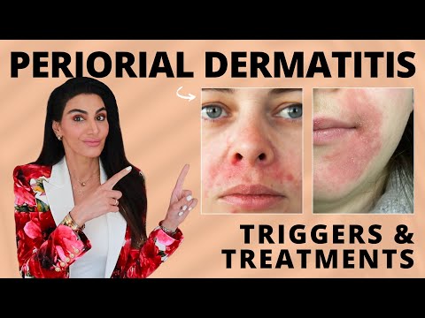 Видео: Периоральный дерматит: причины и рекомендации дерматолога по лечению