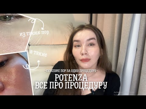 Видео: УМЕНЬШЕНИЕ ПОР ЗА ОДНУ ПРОЦЕДУРУ. Потенза. Все про корейский микроигольчатый RF лифтинг!