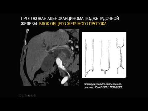 Видео: Рак поджелудочной железы Часть 1