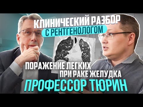 Видео: Клинические разборы с рентгенологом. Профессор Тюрин. Интерстициальные изменения при раке желудка.