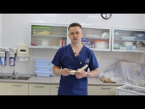 Видео: Лечение тяжелой формы атипичной косолапости. Вавилов Максим Александрович.