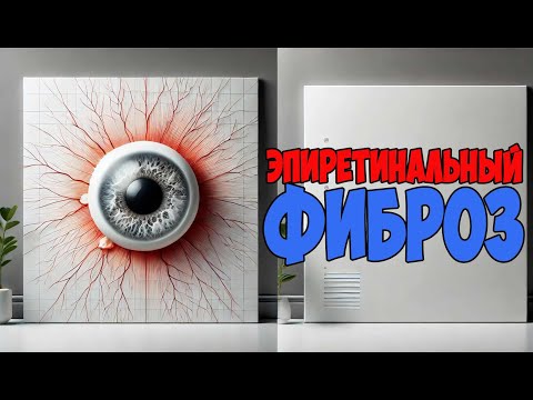 Видео: Эпиретинальный фиброз