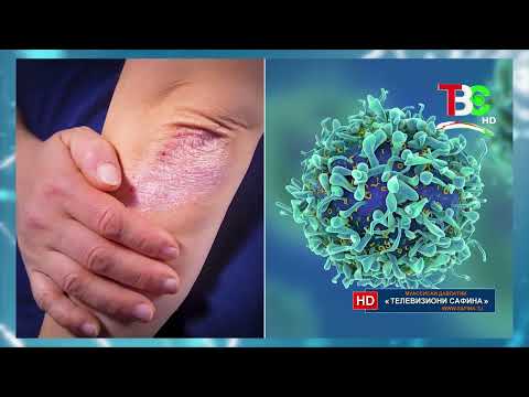 Видео: Ганҷи бебаҳо - Псориаз