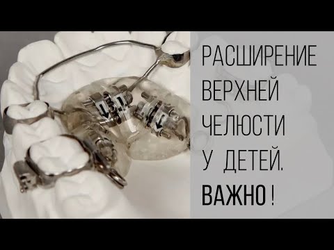 Видео: Расширение верхней челюсти у ребенка. Что важно знать?