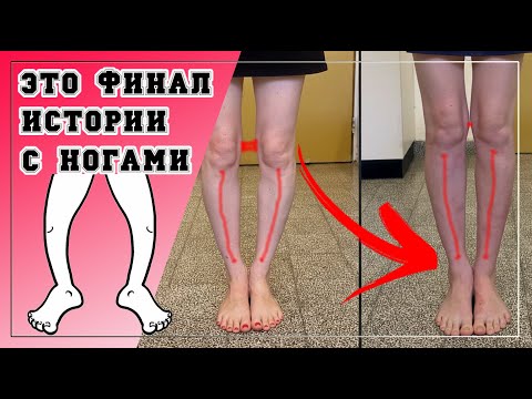 Видео: 22// ФИНАЛ КОРРЕКЦИИ НОГ !!!