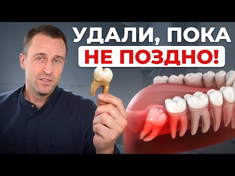 Видео: 5 главных причин срочно избавиться от зубов мудрости! Эти последствия протекают бессимптомно!