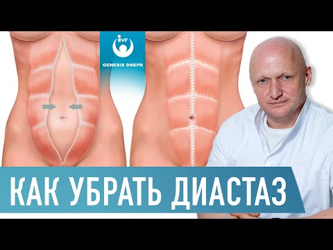 Видео: ДИАСТАЗ (расхождение) прямых мышц живота. Причины, осложнения, лечение |Хирург Шевцов А.Н.