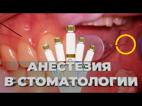 Видео: АНЕСТЕЗИЯ В СТОМАТОЛОГИИ ЖИВАЯ ДЕМОНСТРАЦИЯ ИНФИЛЬТРАЦИОННАЯ, МАНДИБУЛЯРНАЯ, МЕНТАЛЬНАЯ, ТУБЕРАЛЬНАЯ