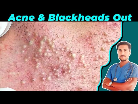 Видео: Лечение акне, чёрных и белых угрей | Пошаговое клиническое удаление