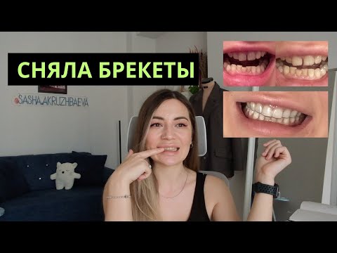 Видео: ПОЧЕМУ ПЕРЕПЛАТИЛА В 2 РАЗА. Брекеты до и после в 37 лет