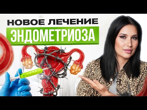 Видео: ВОТ как избавиться от эндометриоза НАВСЕГДА!
