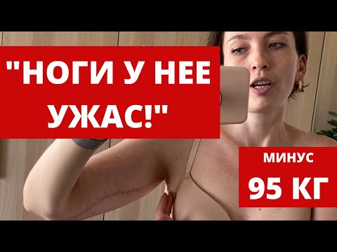 Видео: 5 МЕСЯЦЕВ ПОСЛЕ ПЛАСТИКИ ЖИВОТА И РУК | ДО И ПОСЛЕ | ВПЕРВЫЕ ПОКАЗЫВАЮ НОГИ | ПОХУДЕНИЕ