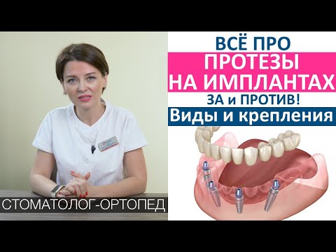 Видео: Протезы на имплантах при полной потере зубов. All on 4. Крепления протезов, виды протезов