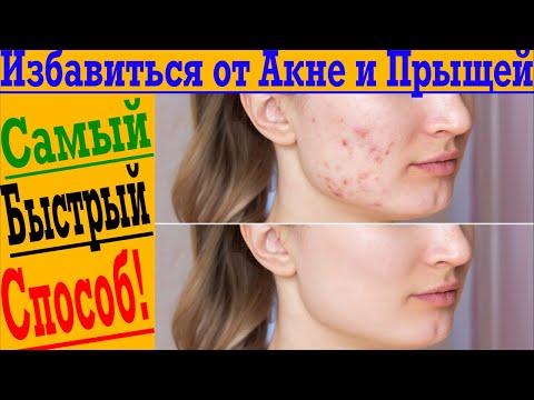 Видео: Самый БЫСТРЫЙ Способ очистить КОЖУ - Избавиться от АКНЕ И ПРЫЩЕЙ!