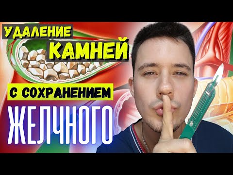 Видео: Желчекаменная болезнь. Холецистэктомия необязательна???