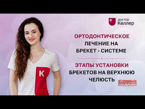 Видео: Ортодонтическое лечение на брекет системе. Этапы установки брекетов на верхнюю челюсть