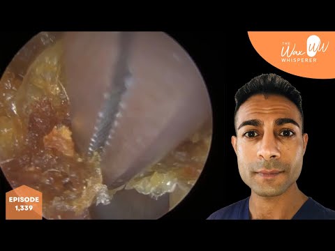 Видео: 1339 - кератозы I/II степени, удаленные и отшелушенные