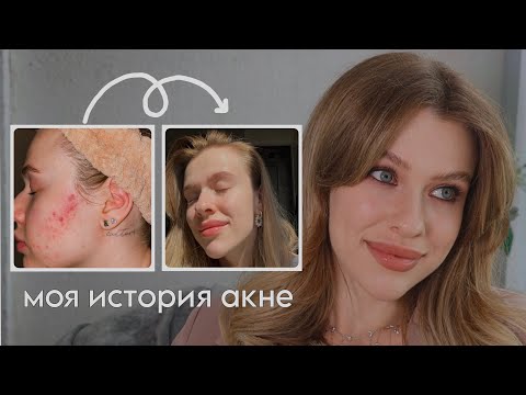 Видео: ДВАЖДЫ ПОБЕДИЛА АКНЕ / Моя история лечения и ухода / МНОГО ФОТО