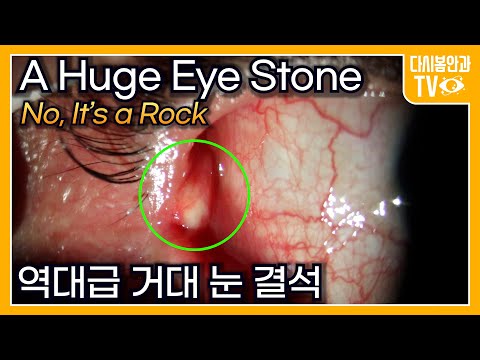 Видео: Удаление огромного камня из глаза (нет, это камень)