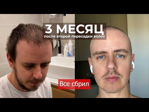 Видео: 3 МЕСЯЦ после ВТОРОЙ ПЕРЕСАДКИ ВОЛОС