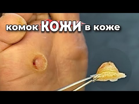 Видео: Ее просто шлифовали, а нужно было вырезать! Глубокая корневая мозоль на стопе