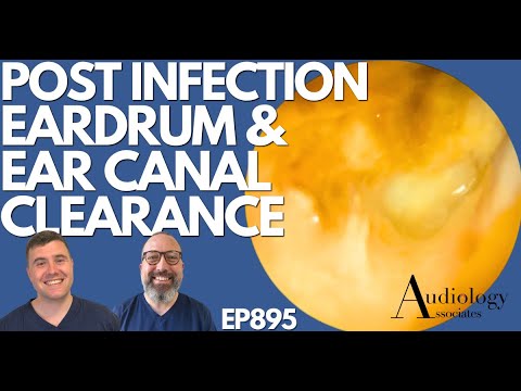 Видео: Постинфекционная очистка барабанной перепонки и слухового прохода - EP895