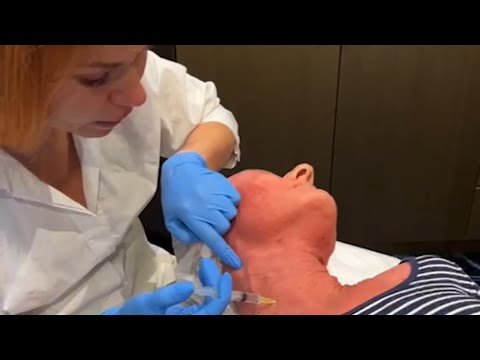 Видео: Лечение Розацеа и Атопического дерматита прямом эфире. Пациент 52 года мазалась гормональными мазями