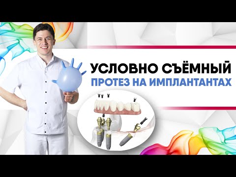Видео: Условно съёмный протез на имплантантах [ All-on-four, All-on-six, Всё на четырёх, Всё на шести ].