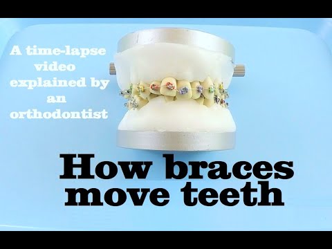 Видео: Вы когда-нибудь задумывались, как работают брекеты? Узнайте здесь!