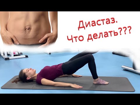 Видео: Упражнения при диастазе / Что делать с диастазом? / Расхождение прямых мышц живота