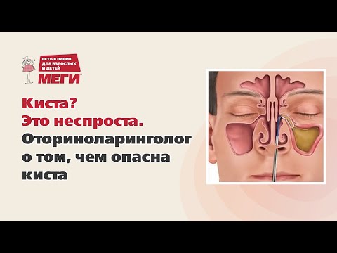 Видео: Киста? Это неспроста. Оториноларинголог о том, чем опасна киста