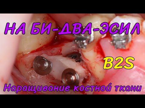 Видео: B2S костная пластика с забором костного блока из ретромолярной области нижней челюсти