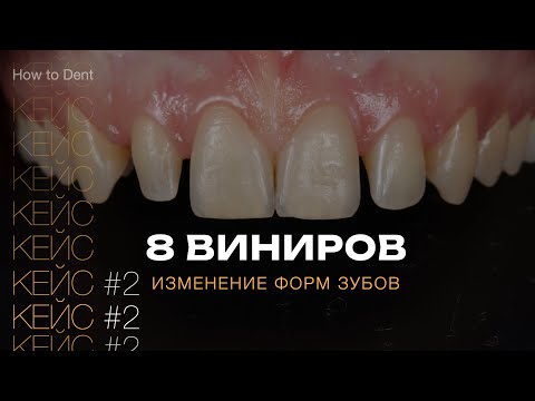 Видео: Изменение формы зубов. Виниры. Шиловидные зубы | Прокопович Виктор.