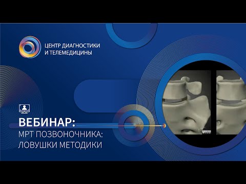 Видео: МРТ позвоночника:  ловушки методики